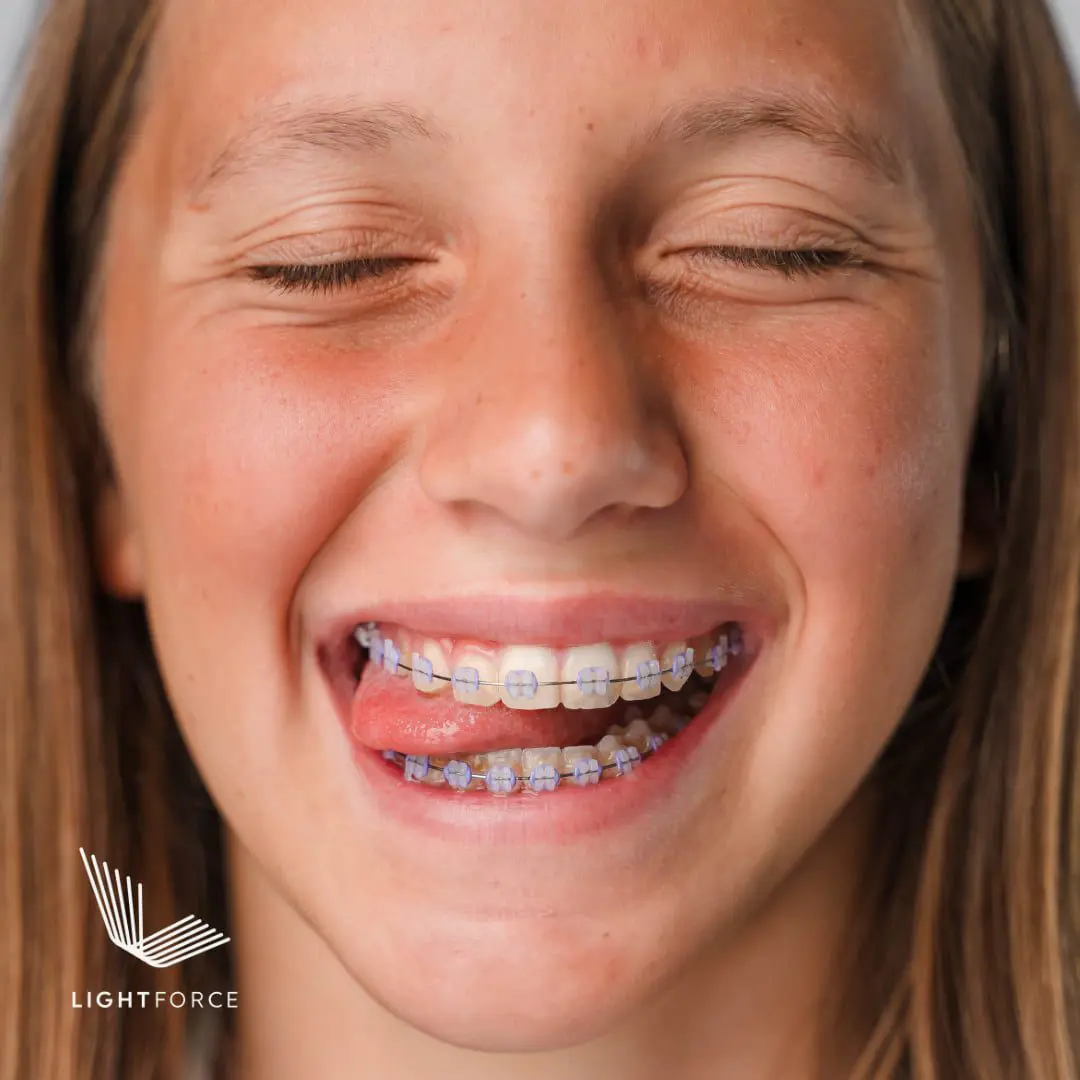A young person smiles with clear braces at Emerald City Orthodontics in Kirkland, WA; eyes closed, tongue up, LightForce logo in corner.