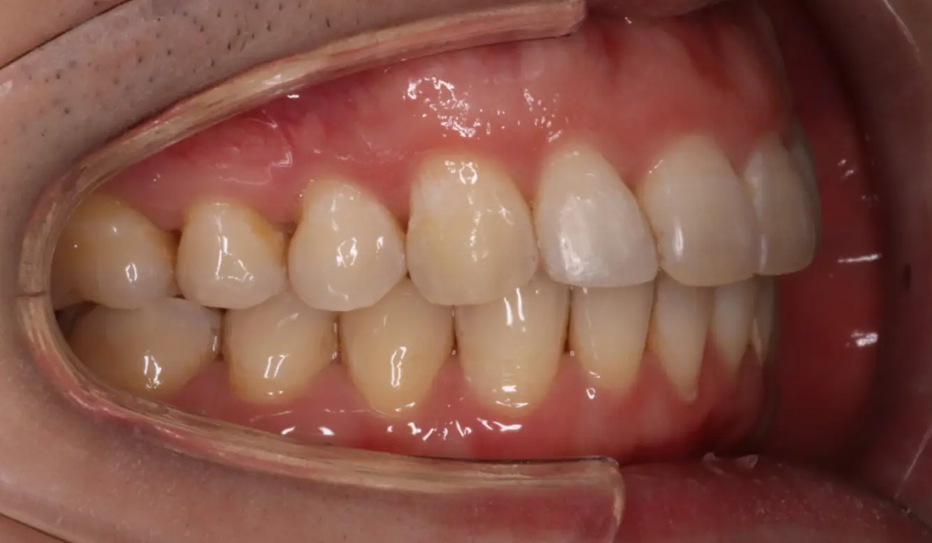 Side view close-up of aligned upper and lower teeth after treatment at Emerald City Orthodontics in Kirkland, WA.