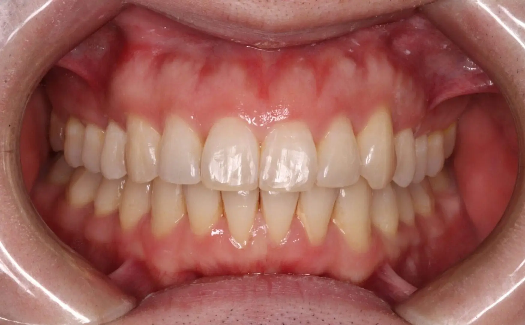 At Emerald City Orthodontics in Kirkland, WA, close-up of retracted lips reveals aligned teeth and healthy gums for treatment comparison.