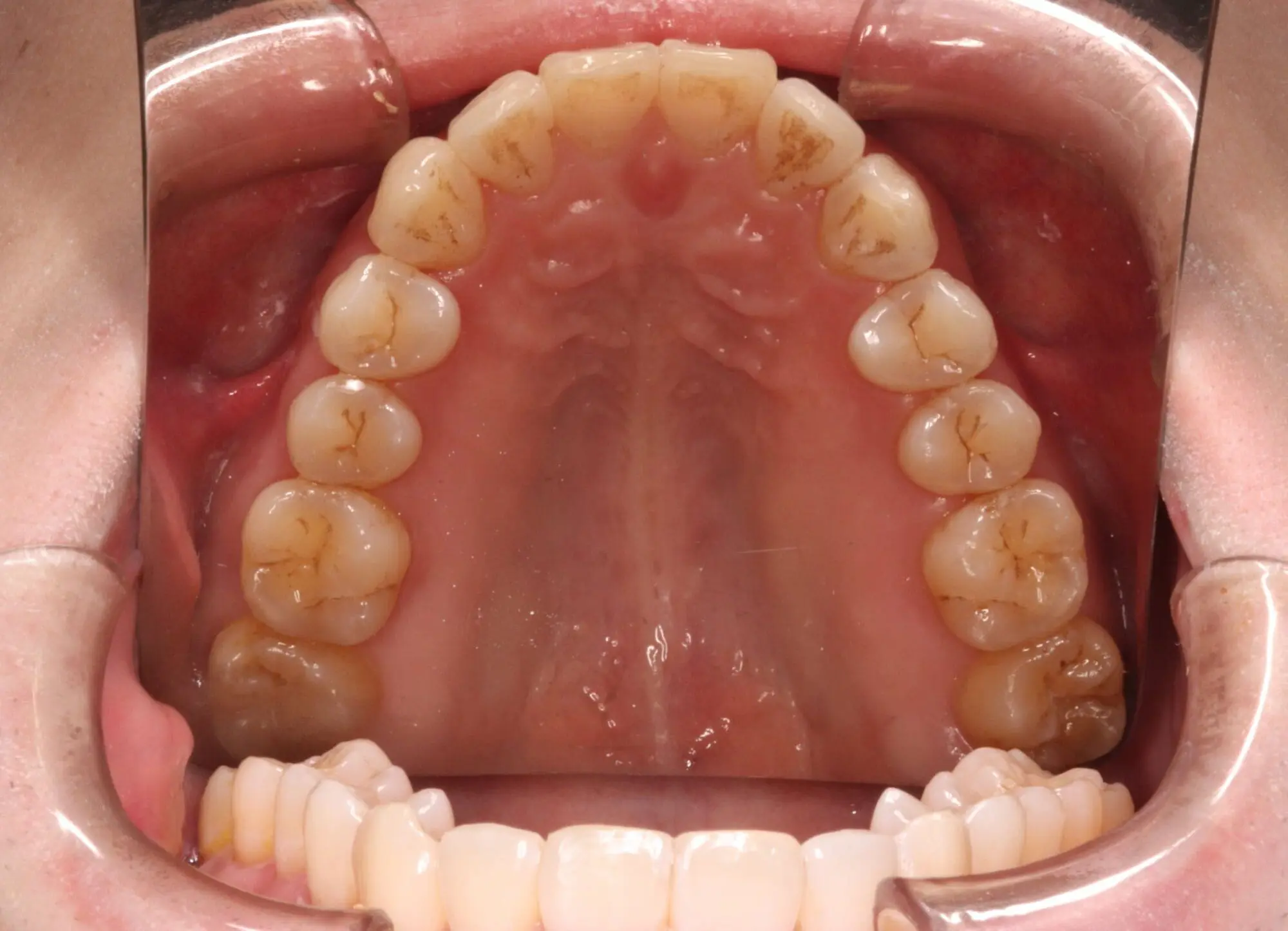 Upper jaw close-up with a cheek retractor at Emerald City Orthodontics in Kirkland, WA, showing dental arches for treatment comparison.