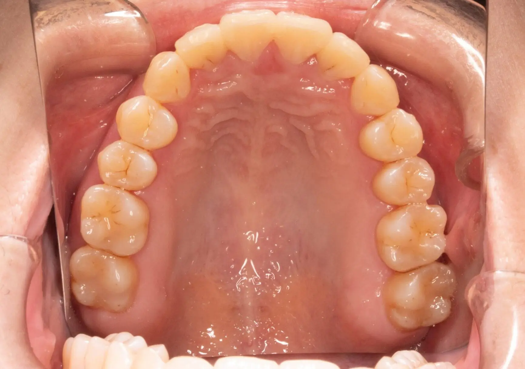 Upper dental arch with teeth, gums, and palate shown inside an open mouth at Emerald City Orthodontics in Kirkland, WA.