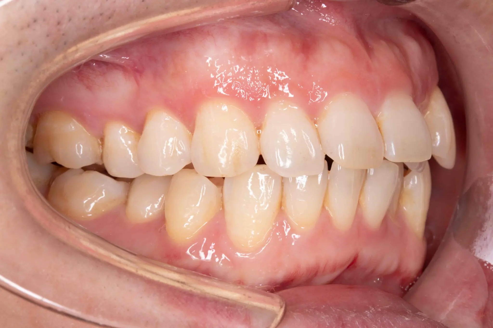 A patient's mouth at Emerald City Orthodontics in Kirkland, WA, showing teeth and gums with cheek retractor for before-and-after comparison.
