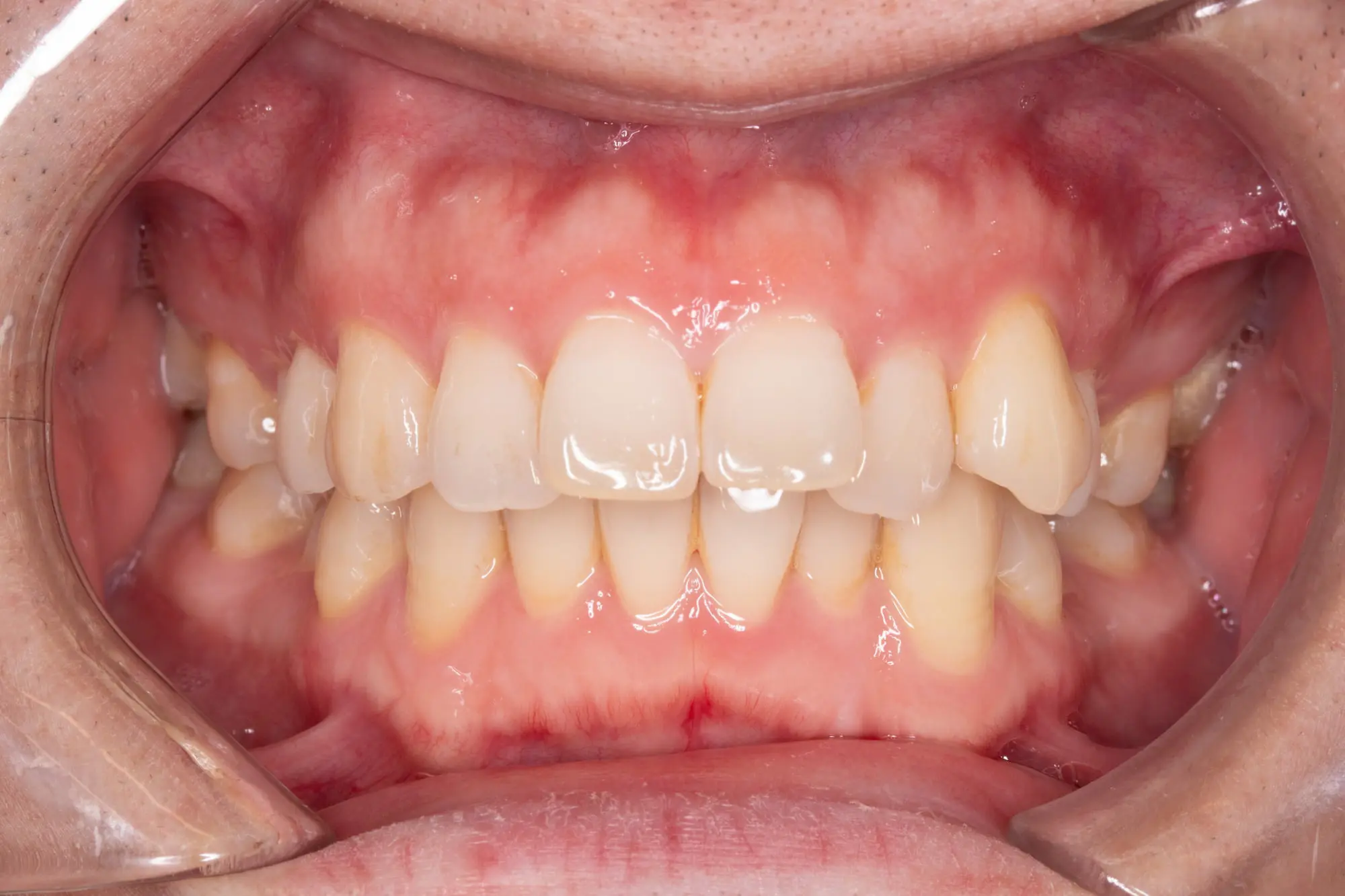 Open mouth with mildly crowded teeth and visible gums at Emerald City Orthodontics in Kirkland, WA—great for before/after comparison.