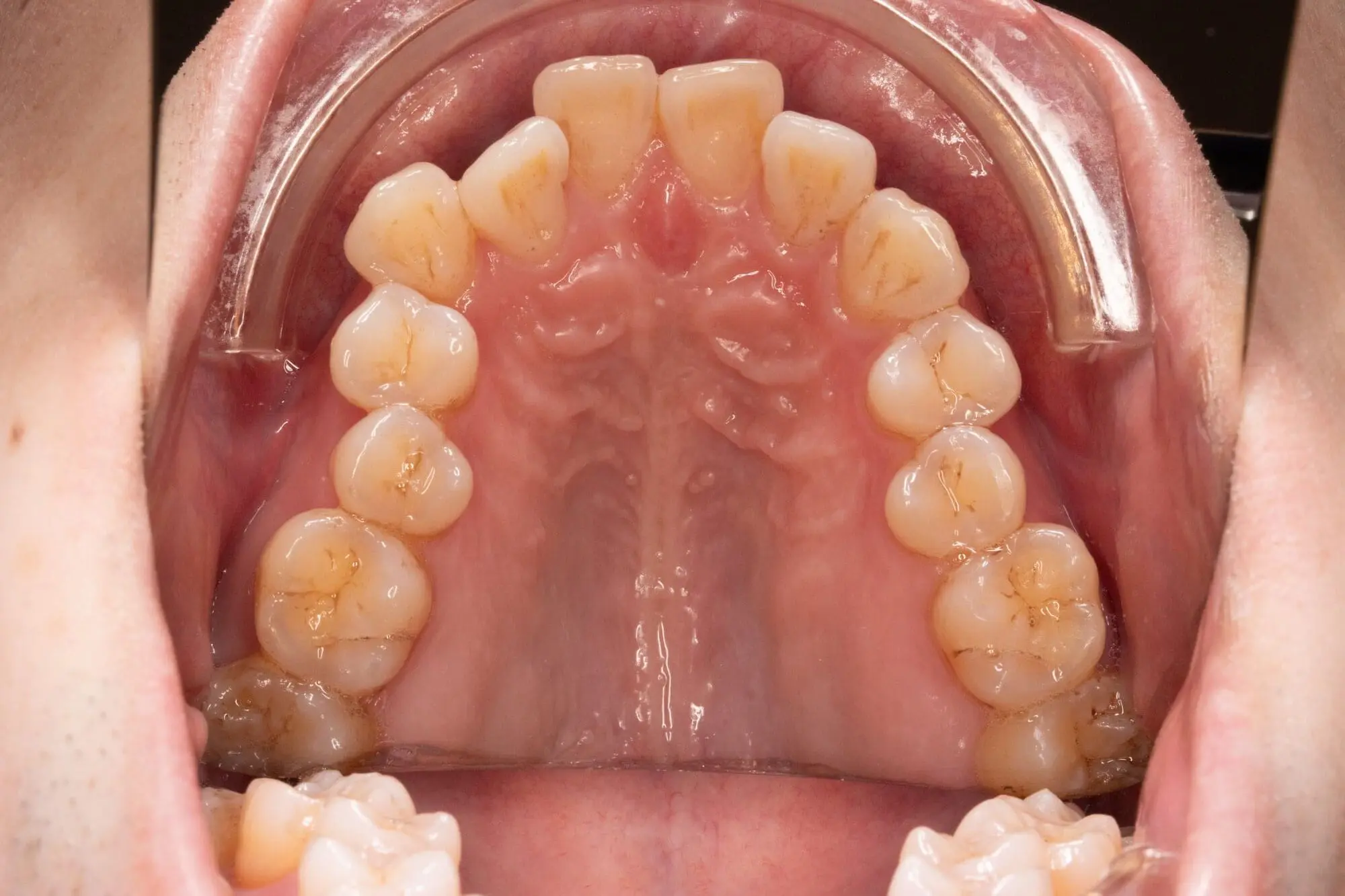 Lower jaw teeth and gums with cheek retractor, perfect for Before vs After shots at Emerald City Orthodontics in Kirkland, WA.