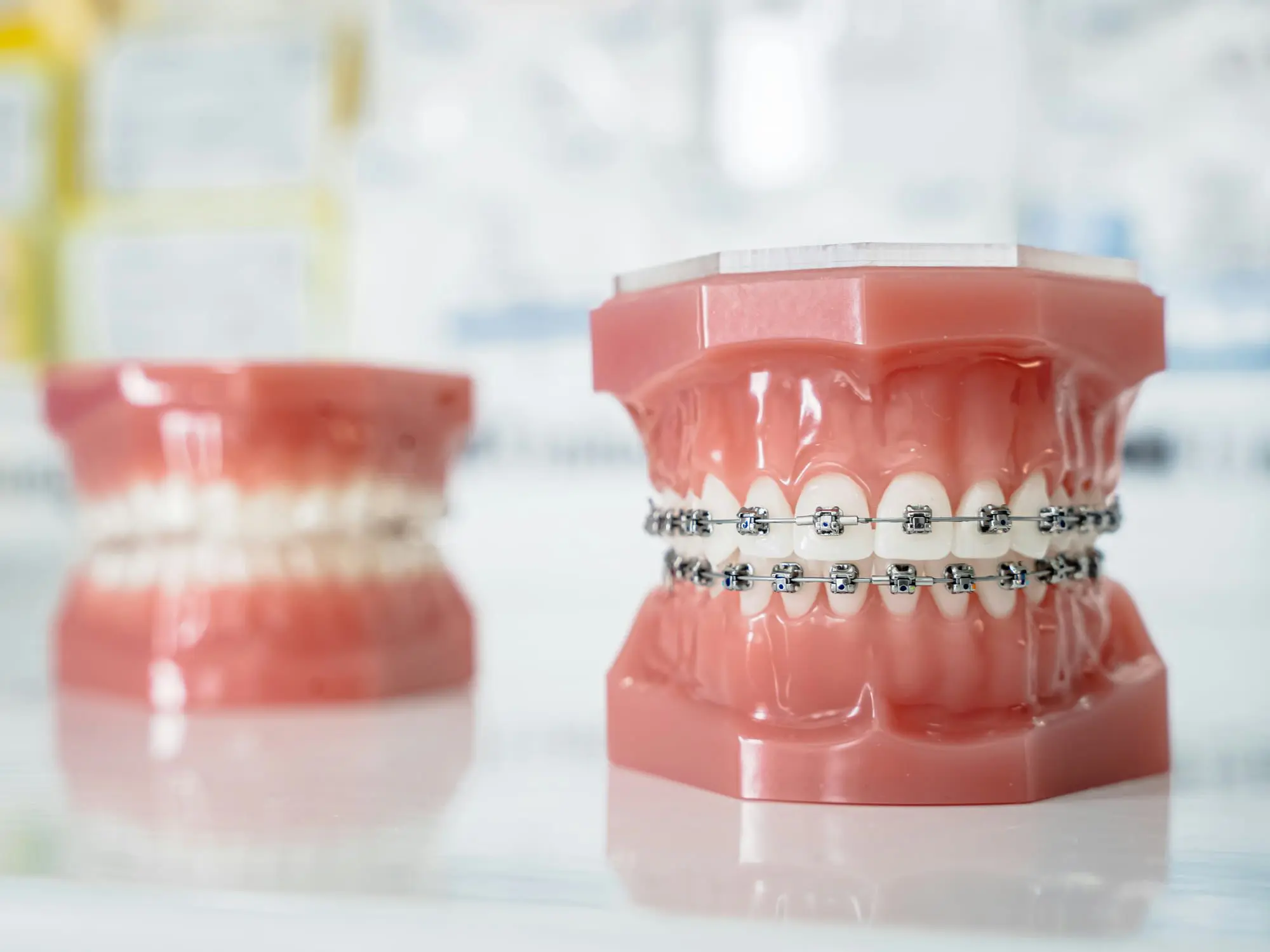 Dental models, one with metal braces and one without, shown on a blurred surface at Emerald City Orthodontics in Kirkland, WA.