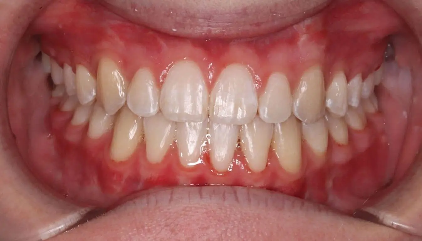 Healthy gums and aligned teeth after Crossbite treatment at Emerald City Orthodontics in Kirkland, WA, shown in open mouth close-up.
