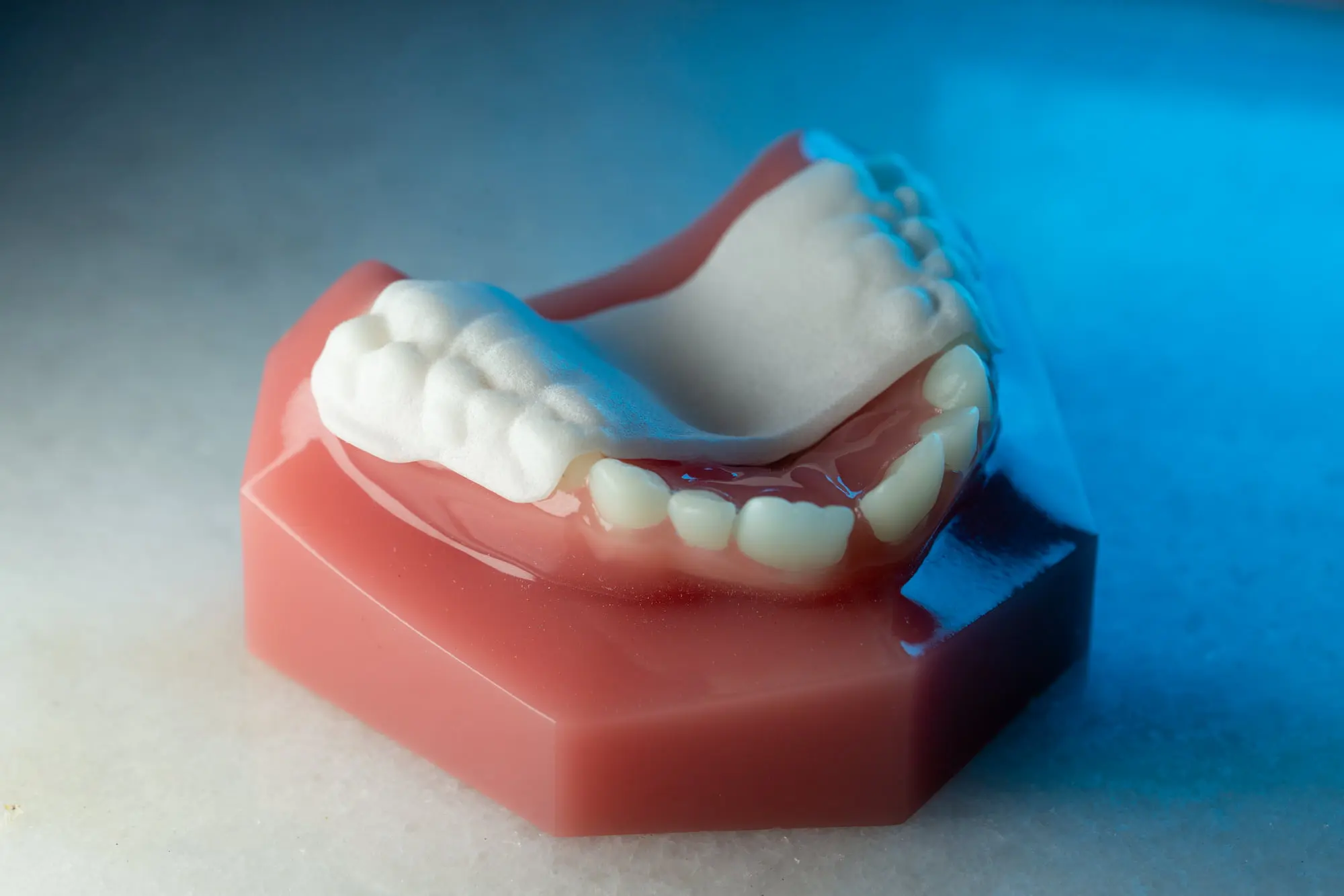 At Emerald City Orthodontics in Kirkland, WA, a dental model displays upper teeth with a partial denture and Invisalign Palatal Expander.