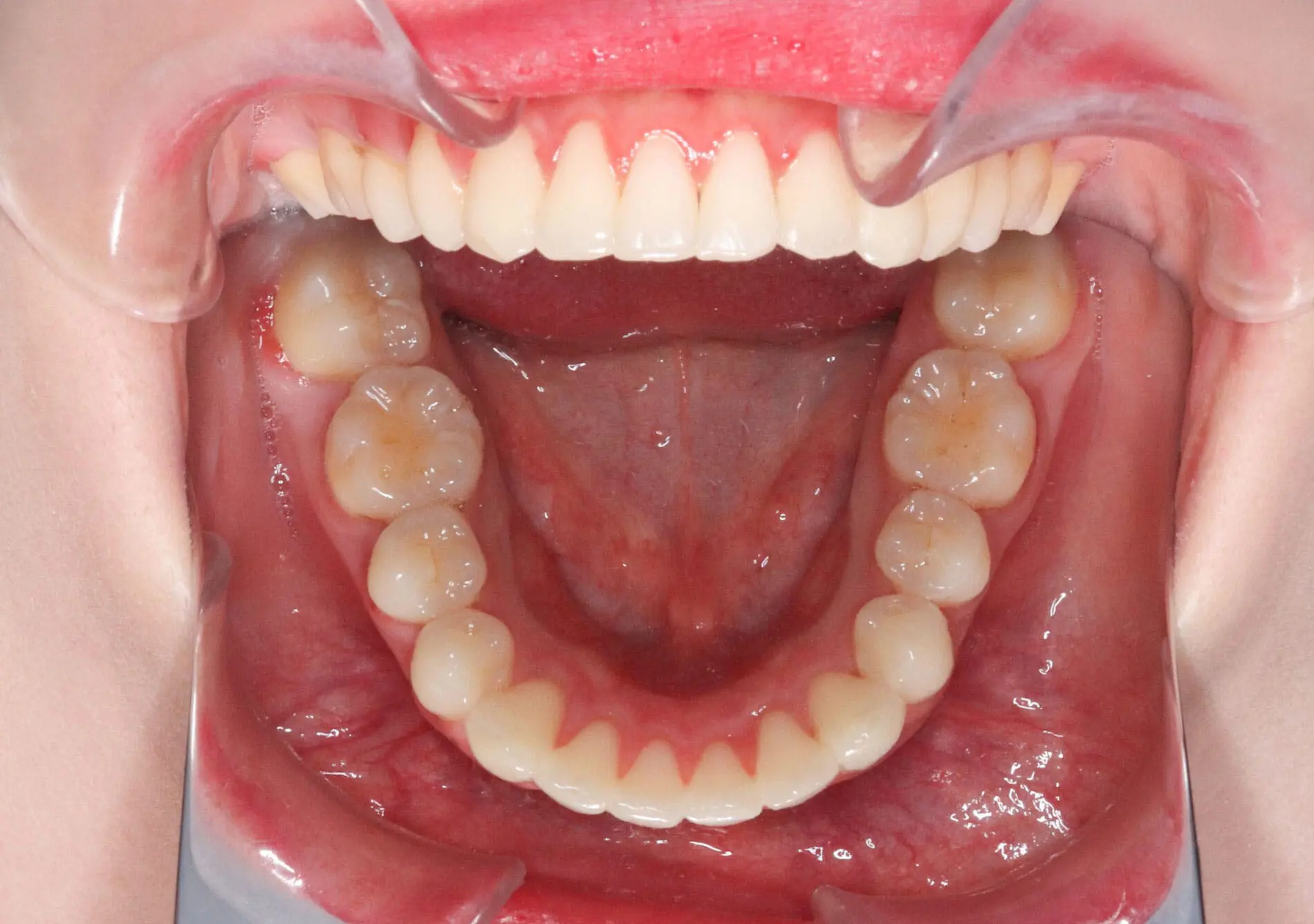 Emerald City Orthodontics in Kirkland, WA: close-up of an open mouth showing lower teeth and gums with cheek retractor before treatment.