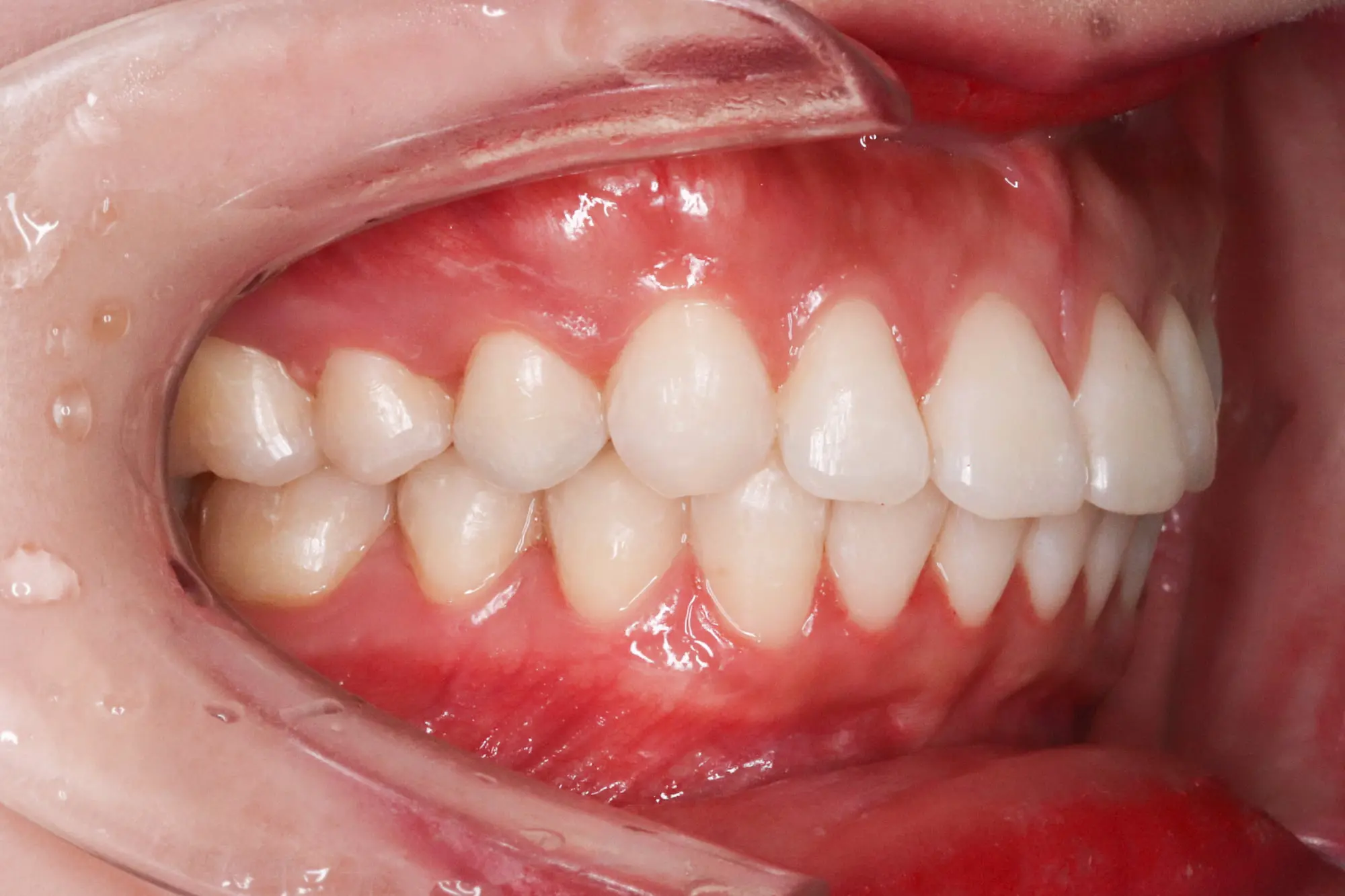 At Emerald City Orthodontics in Kirkland, WA, a close-up shows healthy teeth and gums after deep bite correction with retractor.