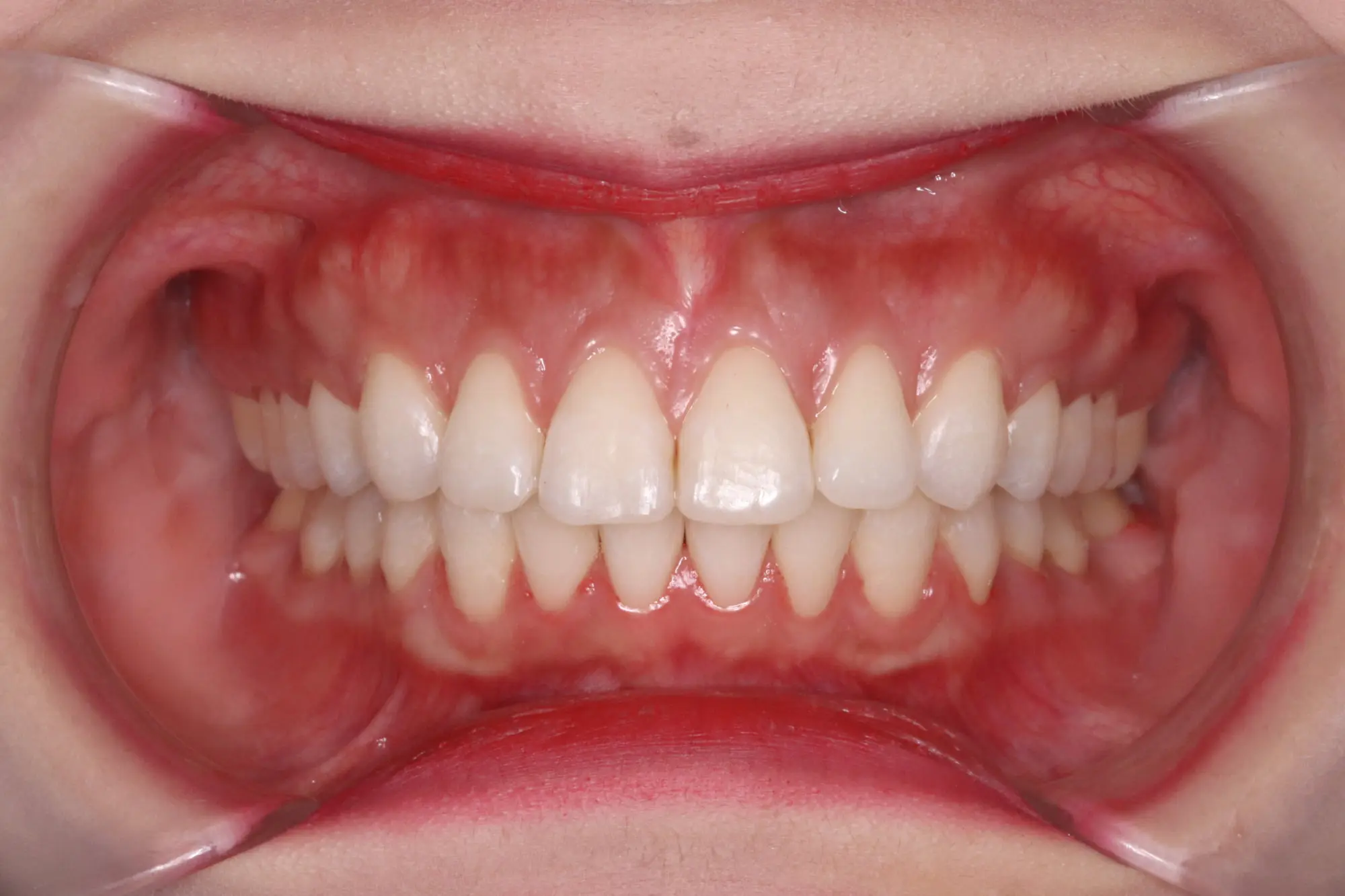At Emerald City Orthodontics in Kirkland, WA, a close-up of healthy teeth and pink gums after deep bite correction is shown.