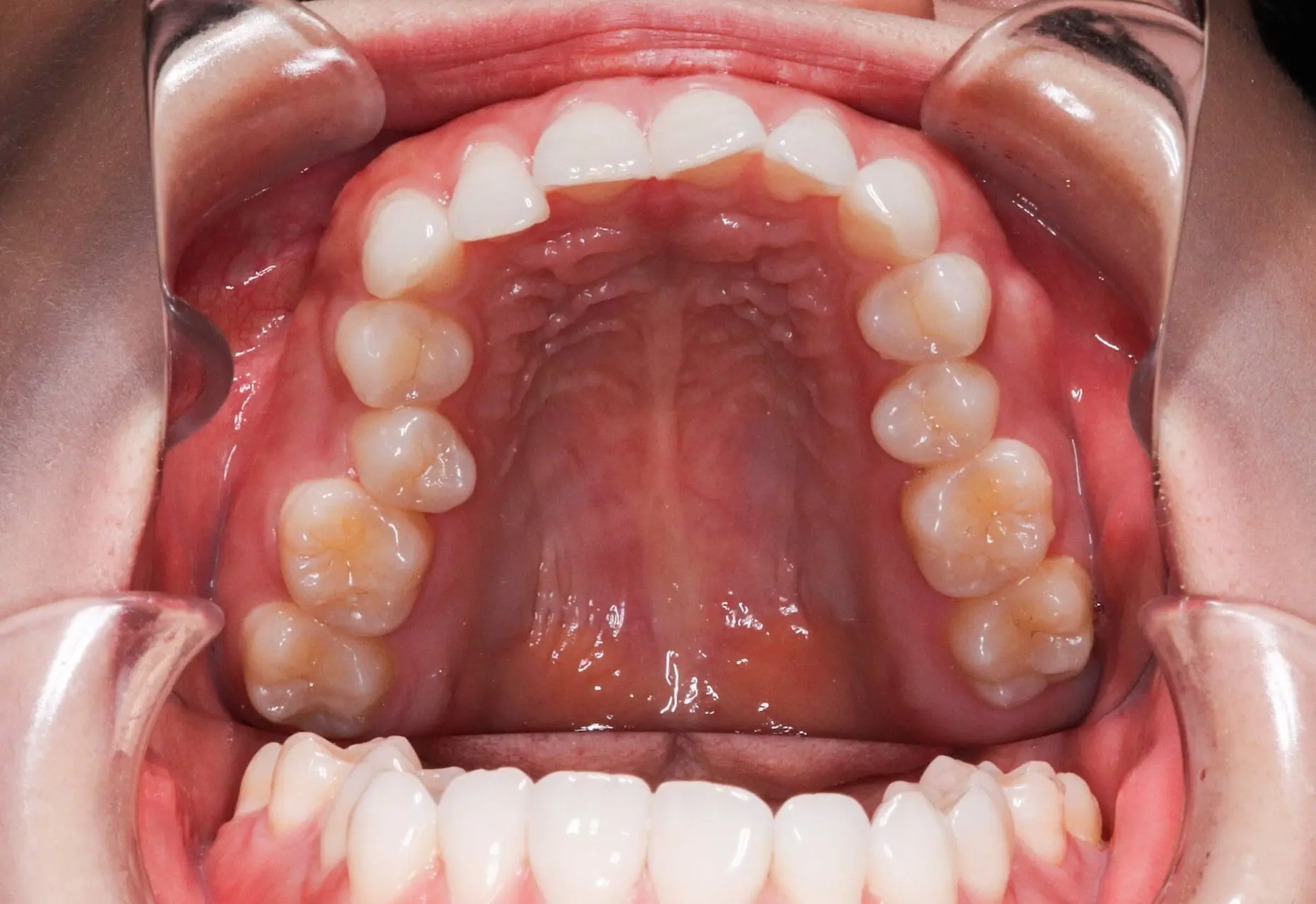 At Emerald City Orthodontics in Kirkland, WA, a mouth is open with cheek retractors revealing upper and lower teeth before crowding.