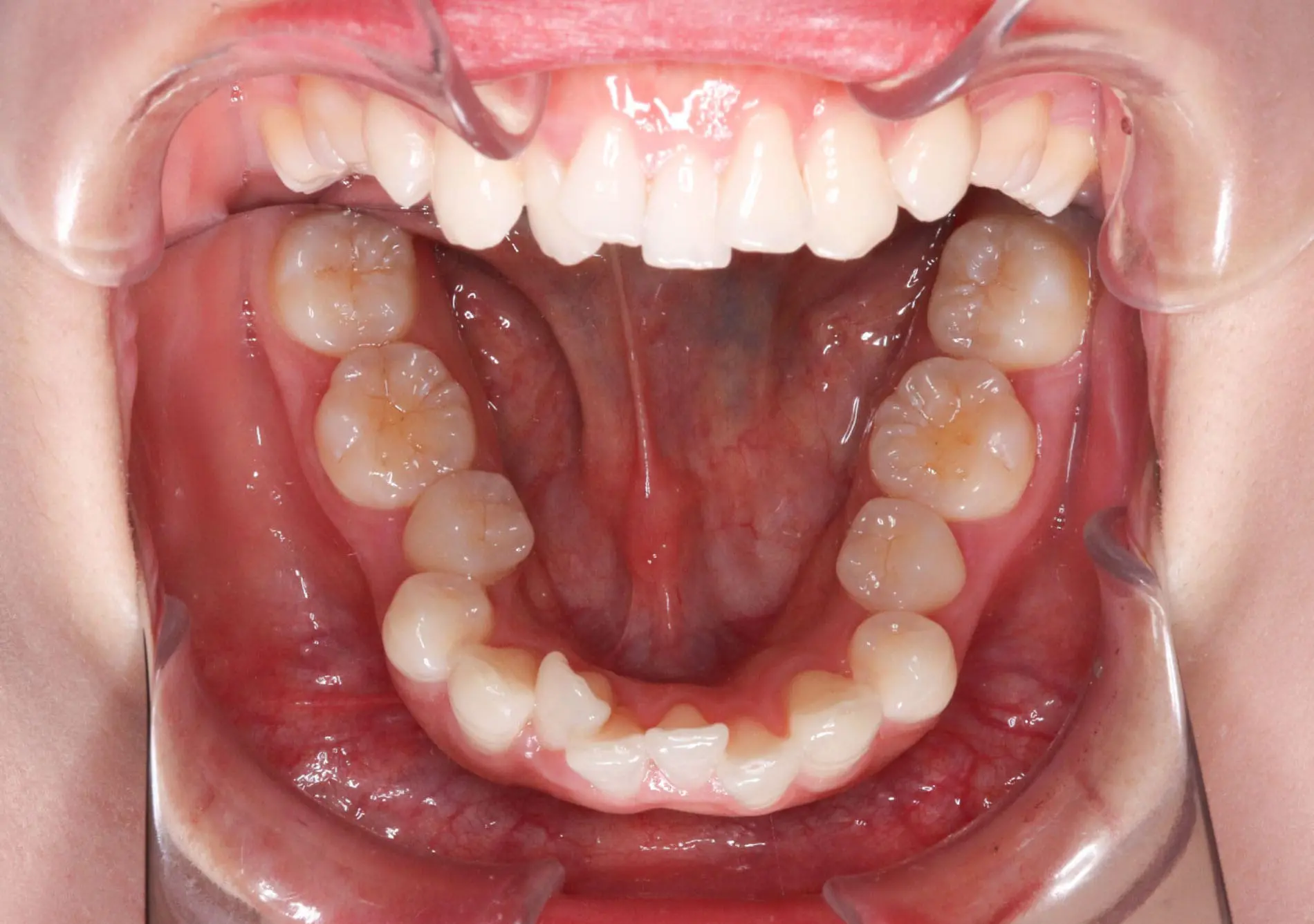 At Emerald City Orthodontics in Kirkland, WA, a close-up shows lower teeth and gums with lips held apart by dental retractors.