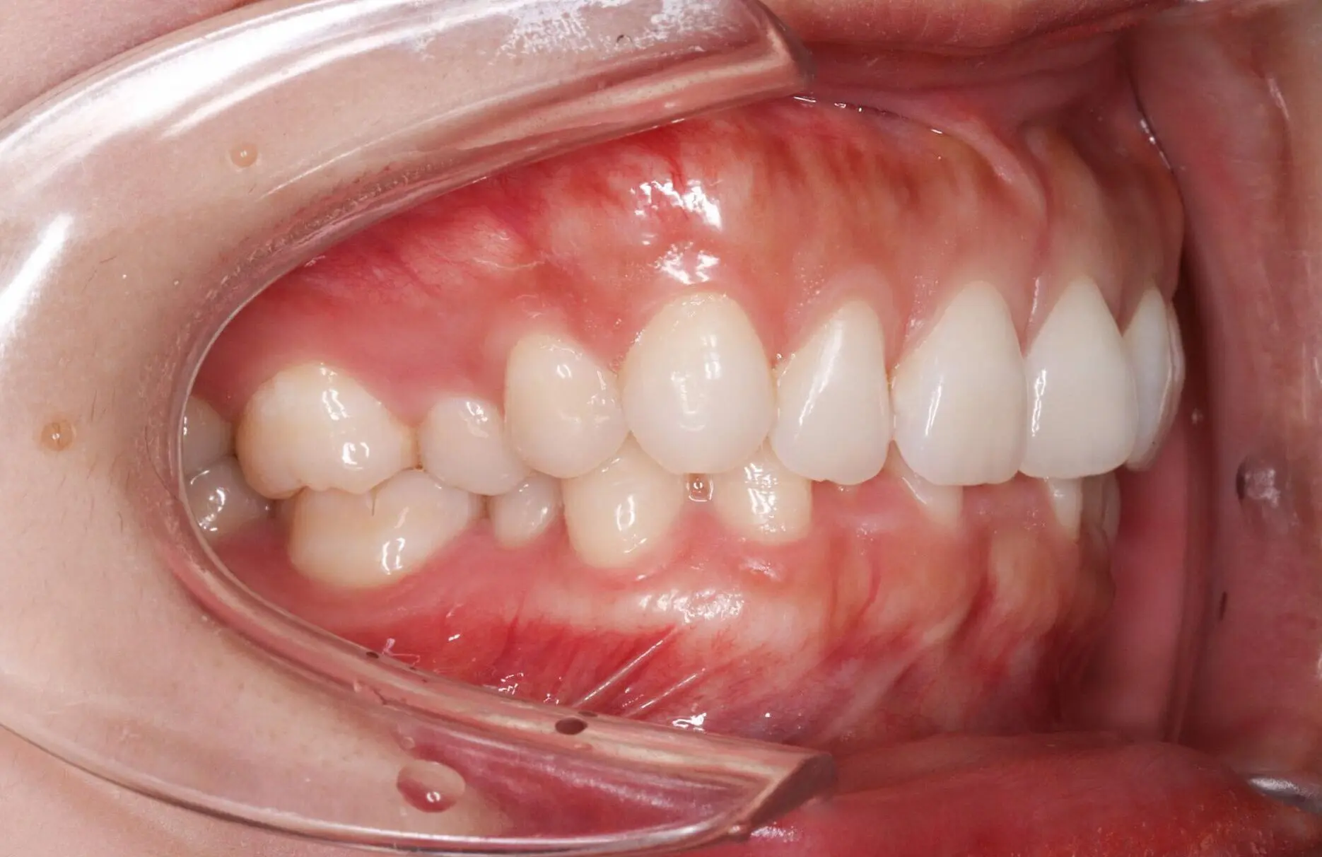 At Emerald City Orthodontics in Kirkland, WA, side view close-up of clean teeth and healthy gums before deep bite correction.