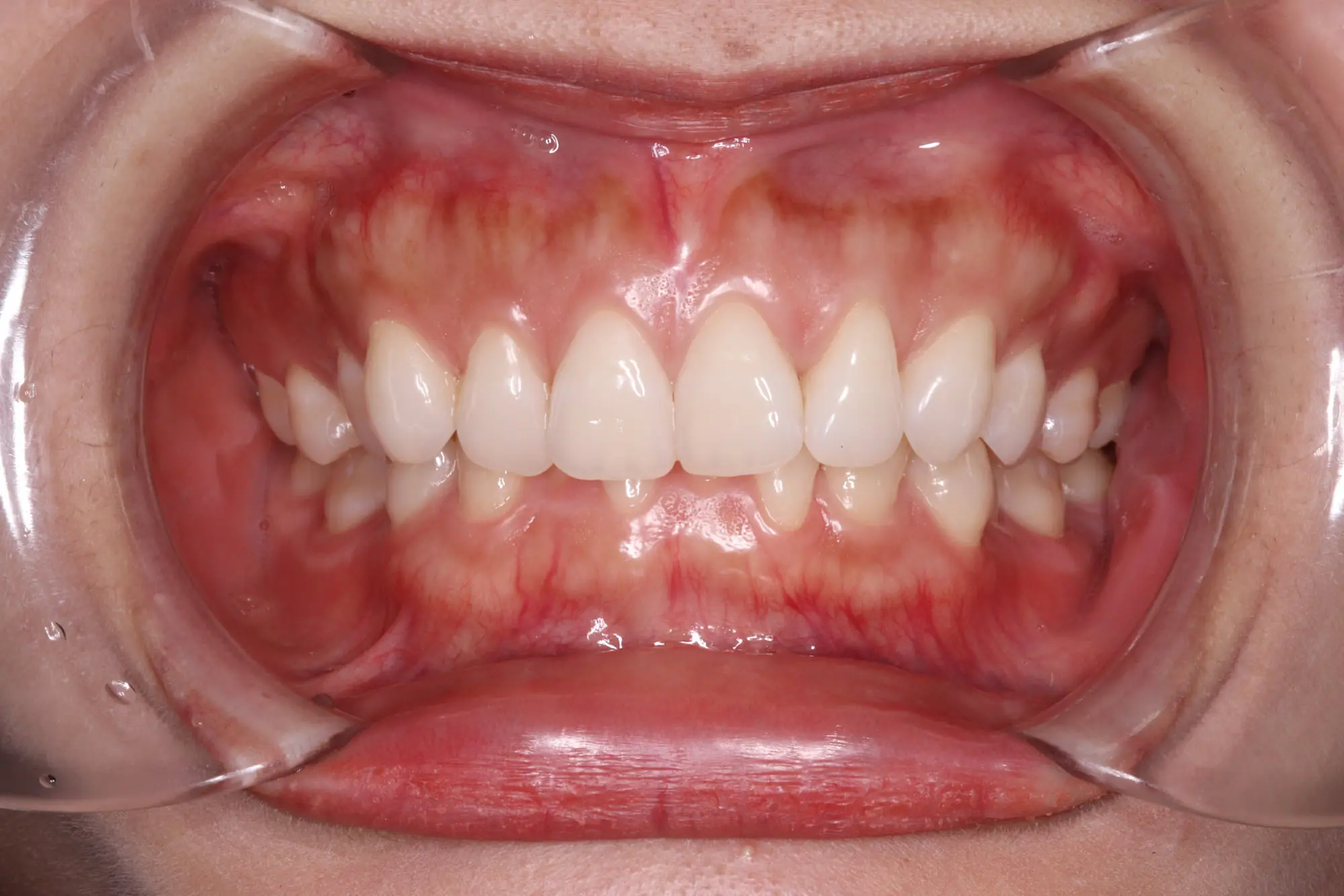 Mouth held open with dental retractor, displaying teeth and gums before deep bite correction at Emerald City Orthodontics in Kirkland, WA.